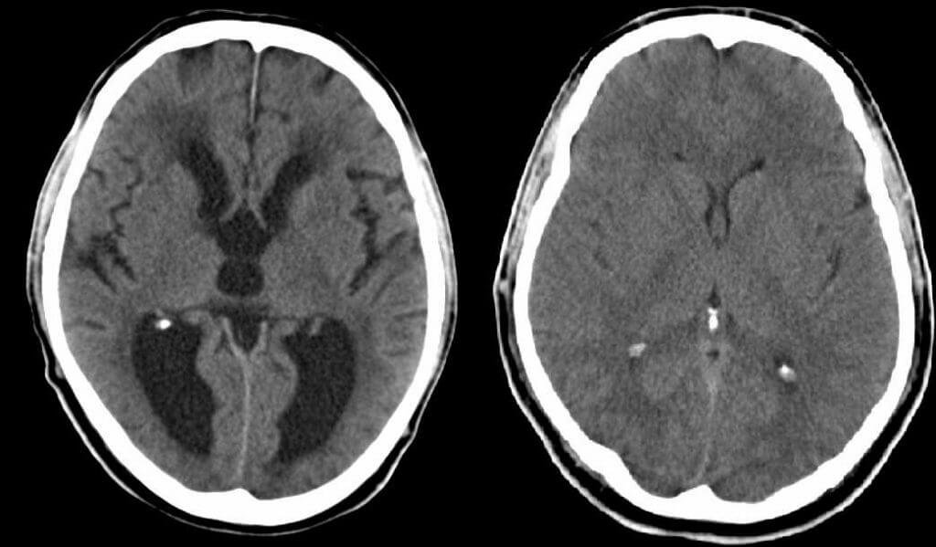Image of CT scan of the brain in a normal patient and a patient with hydrocephalus or pseudotumor cerebri.